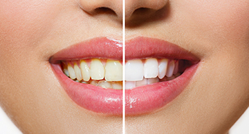 Clareamento Dental a Laser 